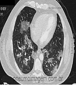 MENOR EFIC�CIA DA VACINA CONTRA GRIPE NOS EUA ESTE ANO - ATUALIZADO EM 17/01/15